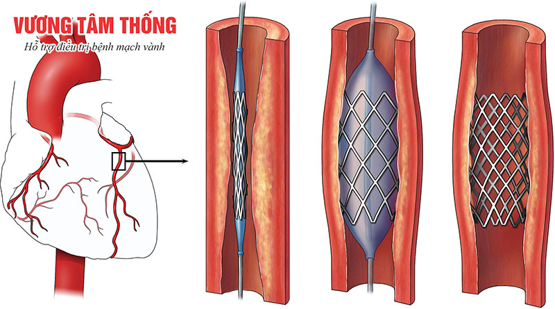 Nong mạch vành và đặt stent trong điều trị bệnh mạch vành.jpg